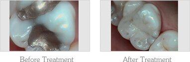 Best Porcelain Tooth Fillings provider in Mesa, AZ area