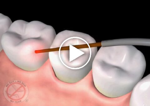 Image of LANAP treatment in Mesa